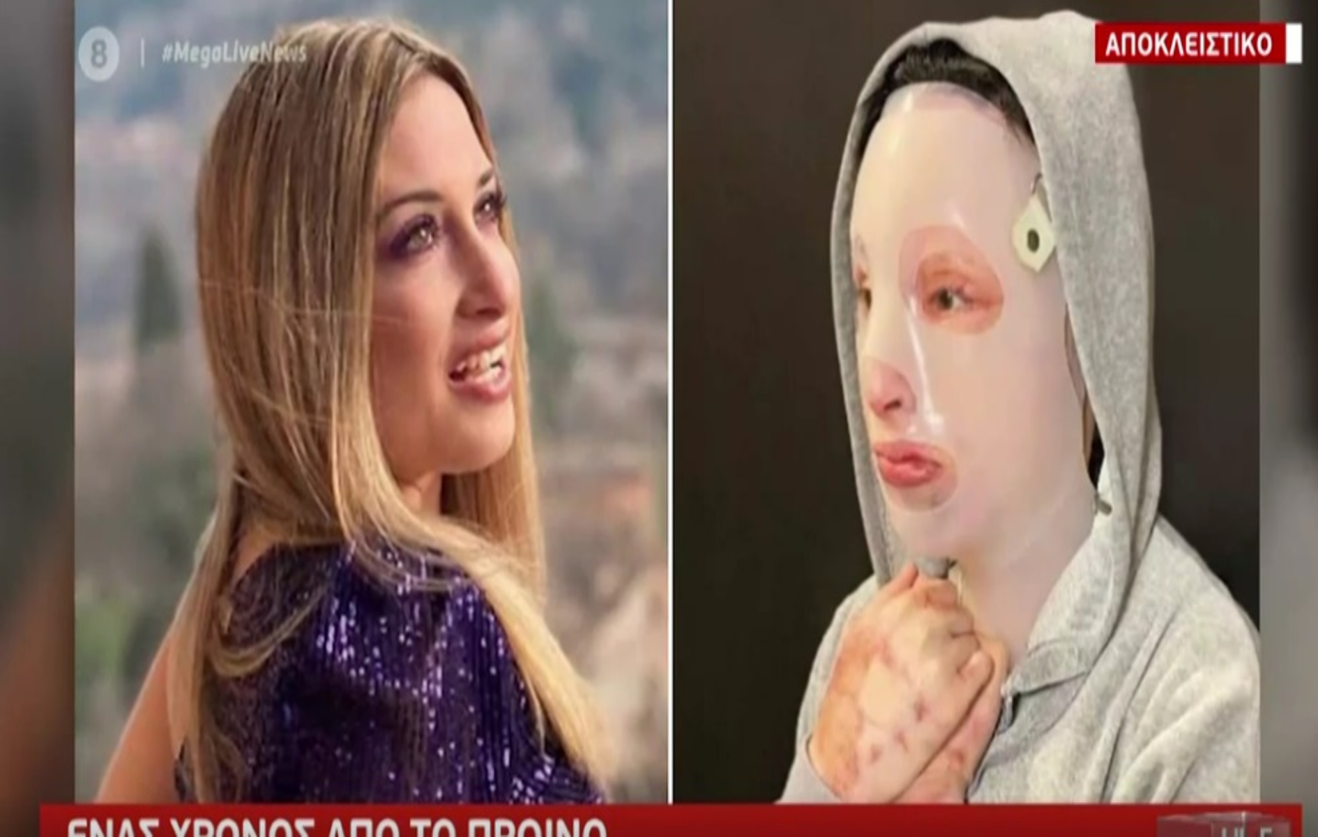 Επίθεση με βιτριόλι νέα